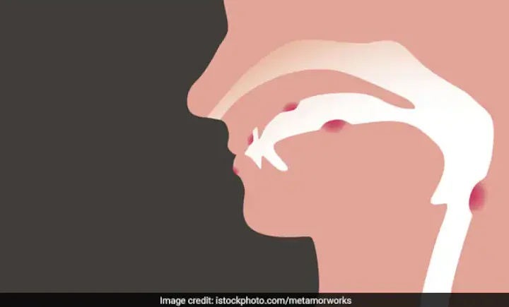 మద్యం, పొగాకుతోనే 62 శాతం నోటి కాన్సర్ కేసులు